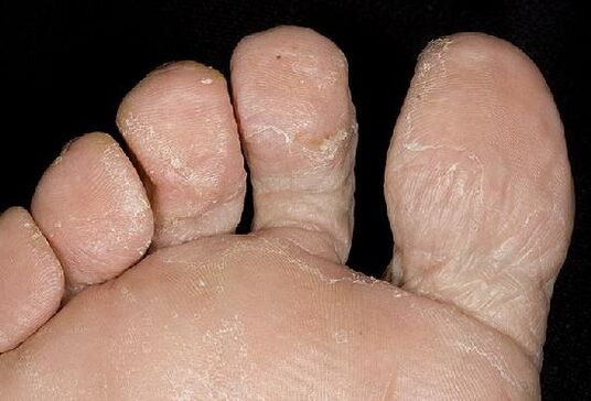 Manifestations of a fungal infection on the foot