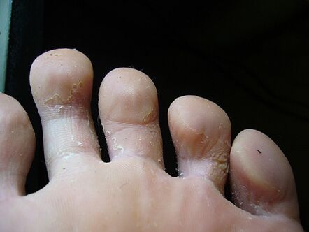 Peeling and peeling of the skin on the feet is a sign of fungus