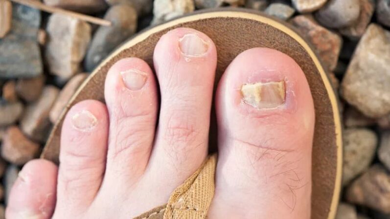 Mikose of nails