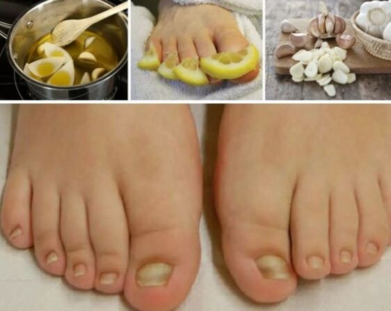 Popular remedies for nail fungi
