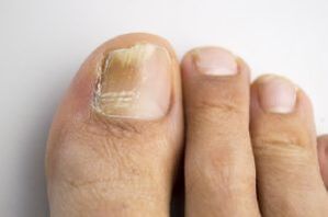The disease with a fungus