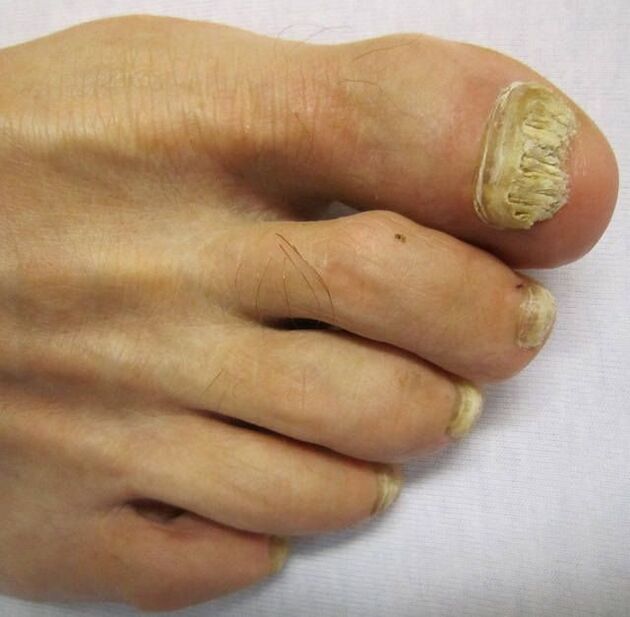 Damage to nail plates