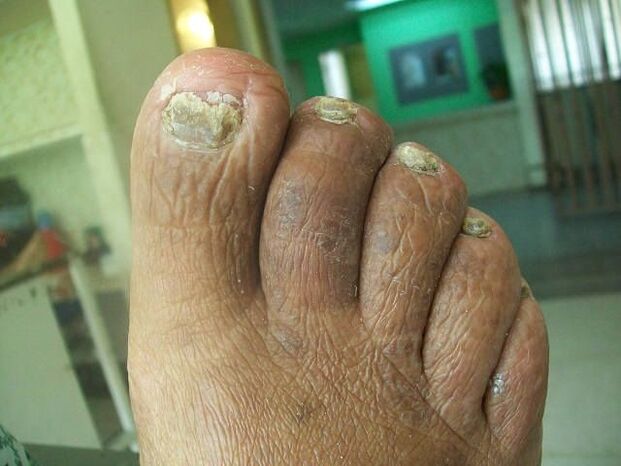 Fungal lesion