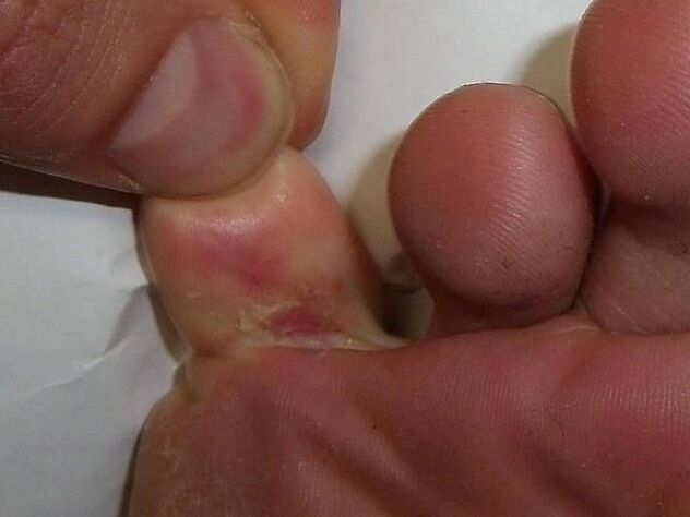 The effect of fungi on the skin