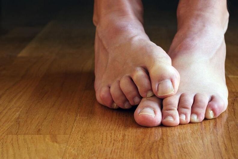 itching of the feet with nail fungus