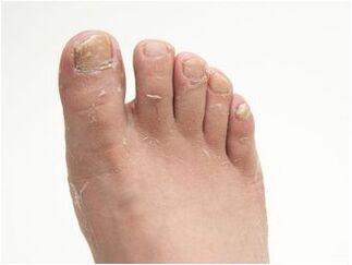 foot fungus symptoms