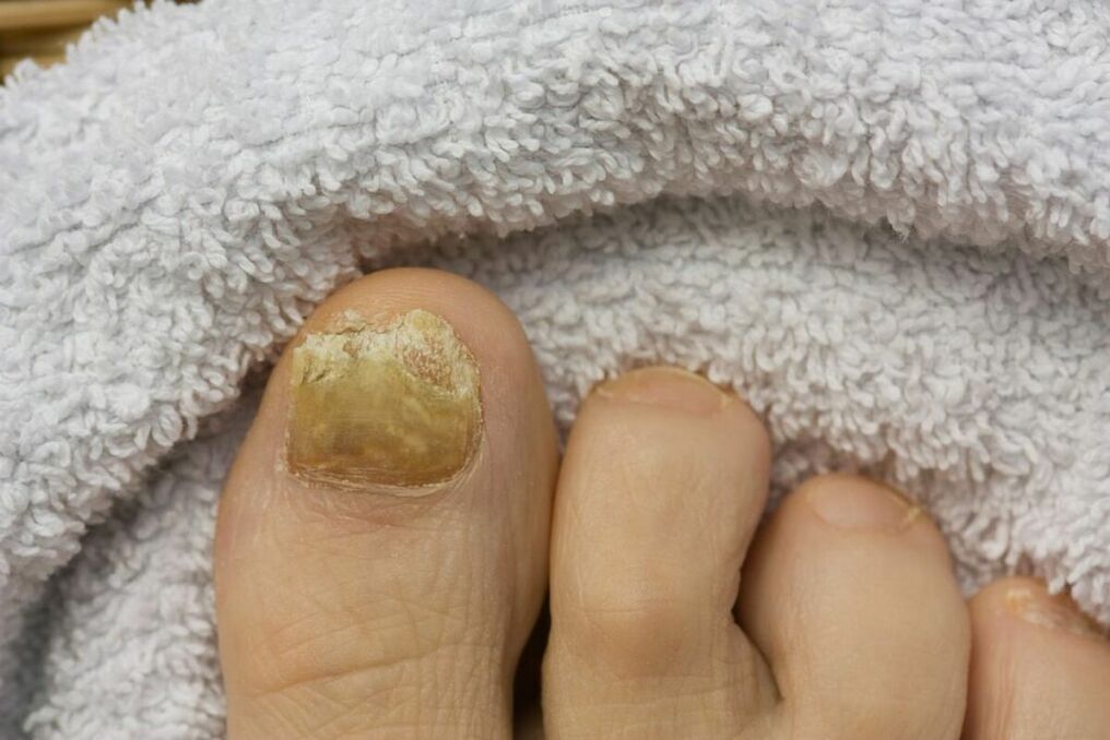 Atrophic stage of the fungus (falling of the toenail parts)