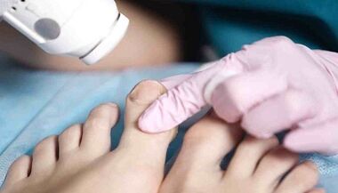 Treatment of fungal hardware standing