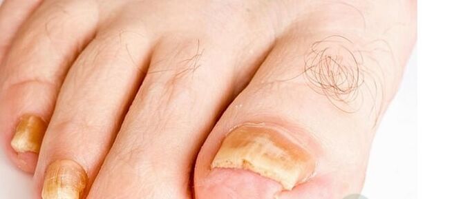 Finger fungal varieties