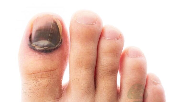 Stage of running the disease with a fungal fungus of the thumb