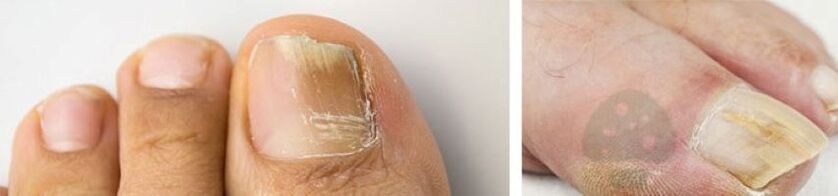 The nails of the thumb nails on the foot