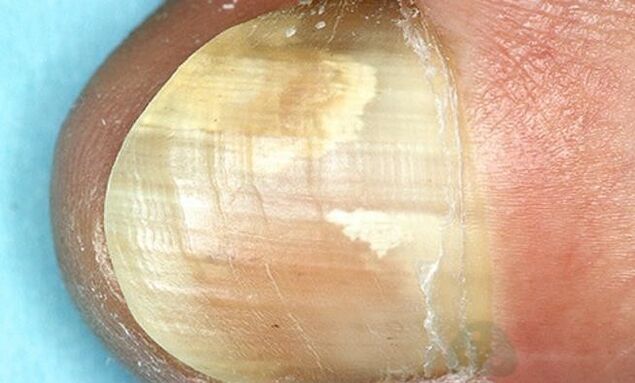 Treatment of fungi fungi with internal action medicines