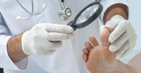 treatment of athlete's foot by a doctor