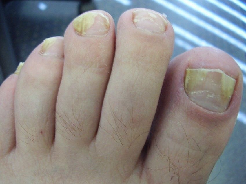 Symptoms of nail fungus