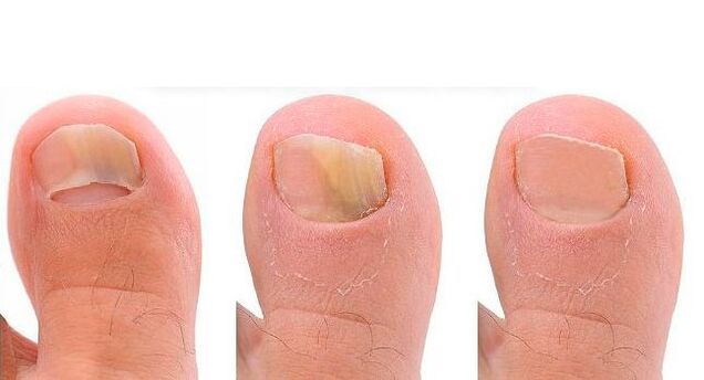 stages of nail fungus development