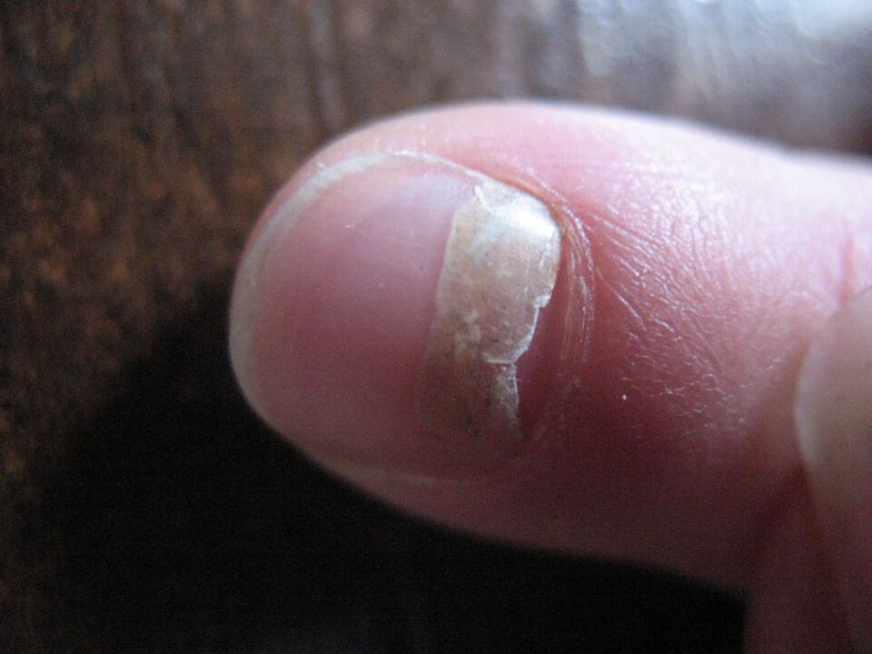 The onycholytic type of fungus is associated with detachment of the nail plate