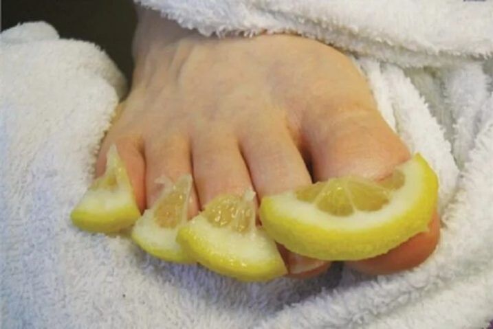 Compresses from lemon drops - a popular remedy for nail fungus